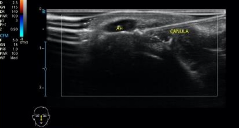 Hialuronidase guiada para ultrassonografia